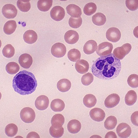 cbc with peripheral smear